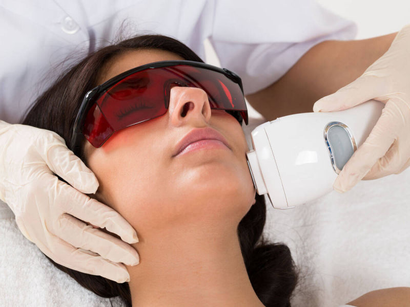 Depilazione Laser Viso